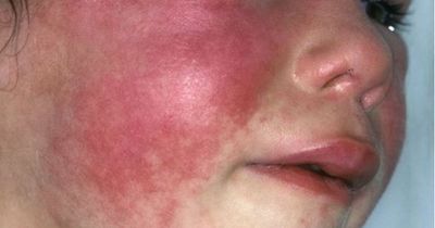Nursery warns parents to look out for symptoms of Strep A and scarlet fever after rise in cases