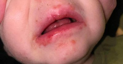 Mum's warning as her two children catch Strep A