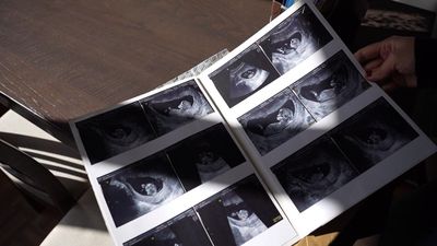 Pregnancy loss in France: Perinatal bereavement remains taboo