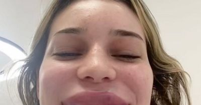 'My lip filler went awfully wrong - I looked like a chipmunk and ended up in hospital'