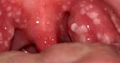 Mum's Strep A warning signs after doctor diagnoses symptoms as tonsillitis