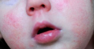 Three doctors on the signs of Strep A to look out for