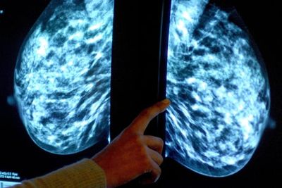 Capivasertib: Scientists hail ‘landmark moment’ as drug slows growth of breast cancer
