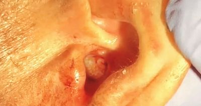 Horrifying moment doctors find maggots in patient's ear after he complained of earache