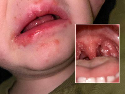 Fifteen children have died from Strep A in the UK in recent weeks. Could an outbreak in the US follow?