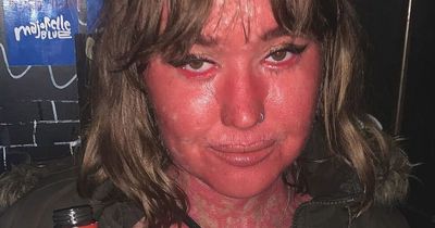 Woman has 'burning' skin which leaves her red and turns eyelids 'inside out'