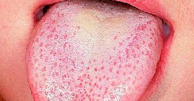 Strep A: Scarlet fever in South West among lowest in country as iGAS cases at average