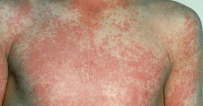 Scarlet fever surges to 1,000+ cases in England and Wales last week