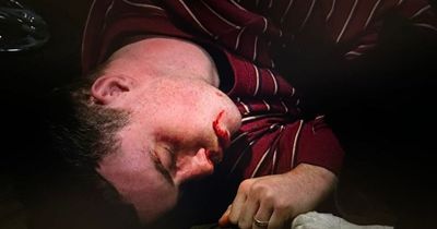 Emmerdale viewers shaken after Vinny left lifeless following bloody attack