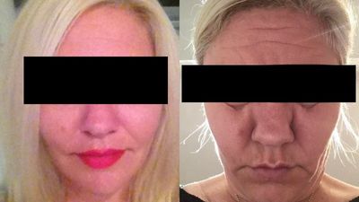 Patients report side effects after popular cosmetic procedure to dissolve facial fillers with unregulated 'off-label' drug