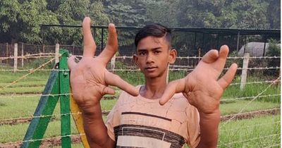 Teenager develops rare syndrome which has given him huge 2ft-long ‘Hulk Hands’