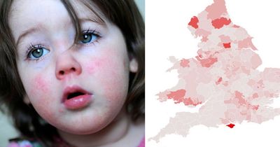 Map shows UK scarlet fever hotspots as infections soar - see how bad it is in your area