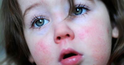Wales reports more than 850 scarlet fever cases in a single week