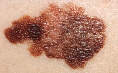 Has Moderna successfully developed a personalised vaccine against melanoma? Maybe