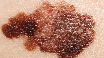 Moderna mRNA melanoma vaccine may be 'the penicillin moment' in cancer treatment, researchers say