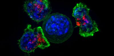 Anti-cancer CAR-T therapy reengineers T cells to kill tumors – and researchers are expanding the limited types of cancer it can target