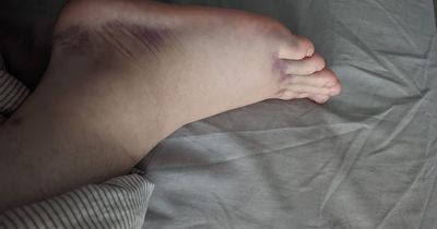 Man says Christmas is ruined after he twisted his ankle on Amazon parcel