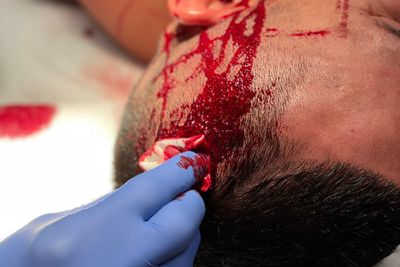 Cub Swanson shares image of ‘cut artery’ in Rafa Garcia’s bloodbath win at UFC Fight Night 216