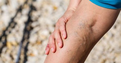 How to prevent varicose veins and how to stop them getting worse