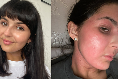 Woman clears skin condition that left her unable to sleep with ‘unbelievable’ £7.99 fix