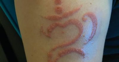 Boy, 13, left with scar for life after allergic reaction to henna tattoo in Bali