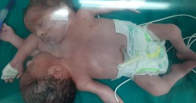 Mum gives birth to baby with two heads and four arms in conjoined twins case