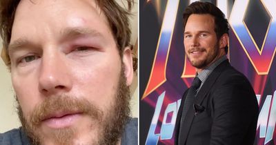 Chris Pratt suffers extreme facial swelling after being stung in the eye by 'angry bees'