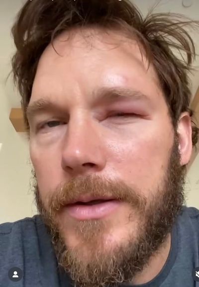 Chris Pratt reveals he was stung in eyeball by bee in video