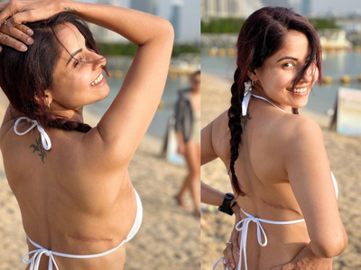 Chhavi Mittal shows-off her breast cancer scar with pride; says “this is what I earned this year”