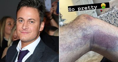 Gary Lucy shows off injuries from Boxing Day car crash after he admits he's 'lucky to be alive'