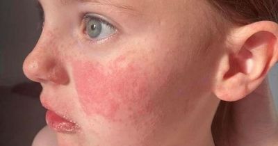 Scottish mum warns of unusual Strep A 'sunburn skin' symptom