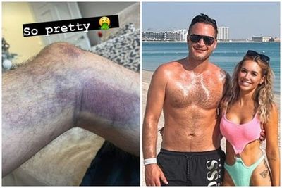Gary Lucy reveals nasty bruising after surviving Boxing Day car crash
