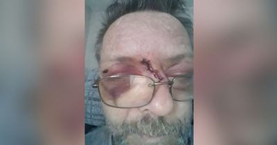 Horrific injuries of homeowner left with broken eye sockets in garden attack