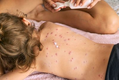 Why chickenpox can increase stroke risk