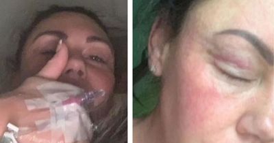 Michelle Heaton shares shocking pictures from alcohol battle as she celebrates sobriety milestone