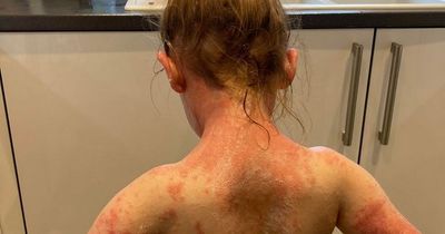 Mum warns of Strep A 'sunburn skin' symptom as her child hit with 'head-to-toe rash'