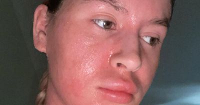 Woman shares horror effects of eczema creams that made skin 'ooze' and her hair fall out