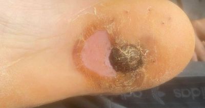 Mum told son's foot may need to be amputated after he stamped on vape pen