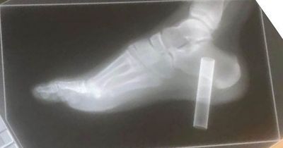 Boy, 13, told he may lose his foot after trying to 'crush vape pen like a Coke can'