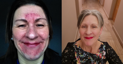 'I looked like a monster' Woman suffered painful skin condition after workplace bullying