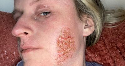 Woman housebound after cream she used to treat eczema caused weeping scabs