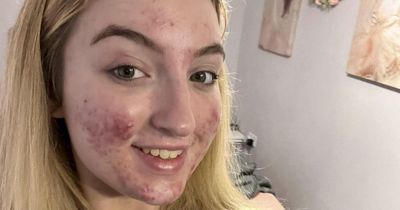 Teenager has TikTok account shut down because her acne was deemed ‘gruesome content’