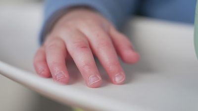 Health authorities warn of a jump in invasive strep A infections among children