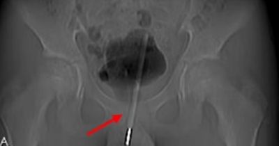 Boy, 12, forced to have surgery after getting thermometer stuck up his penis