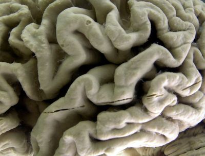 Alzheimer's drug that modestly slows disease OK'd by FDA