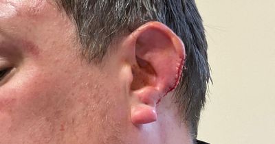 'It's your ear it's on the floor' - An expert explains why ears are targeted in fights