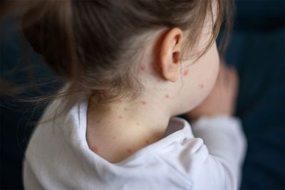 How a measles outbreak happened in Ohio