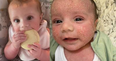 Parents rave over 'miracle in a jar' that they swear clears up eczema overnight