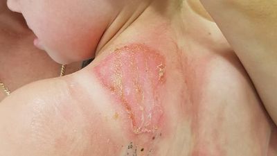 Sunburn warning after Adelaide children's hospital burns unit detects spike in severe cases