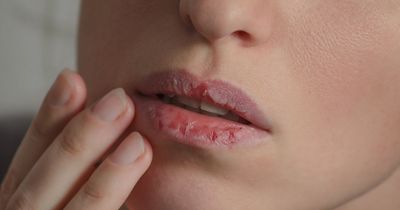 Dermatologist warns against lip balm as remedy causes 'vicious cycle' in skin
